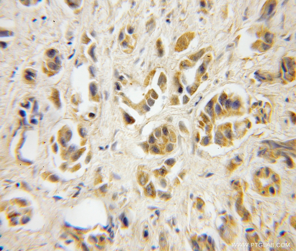 Immunohistochemistry (IHC) staining of human prostate cancer tissue using TBCA Polyclonal antibody (12304-1-AP)