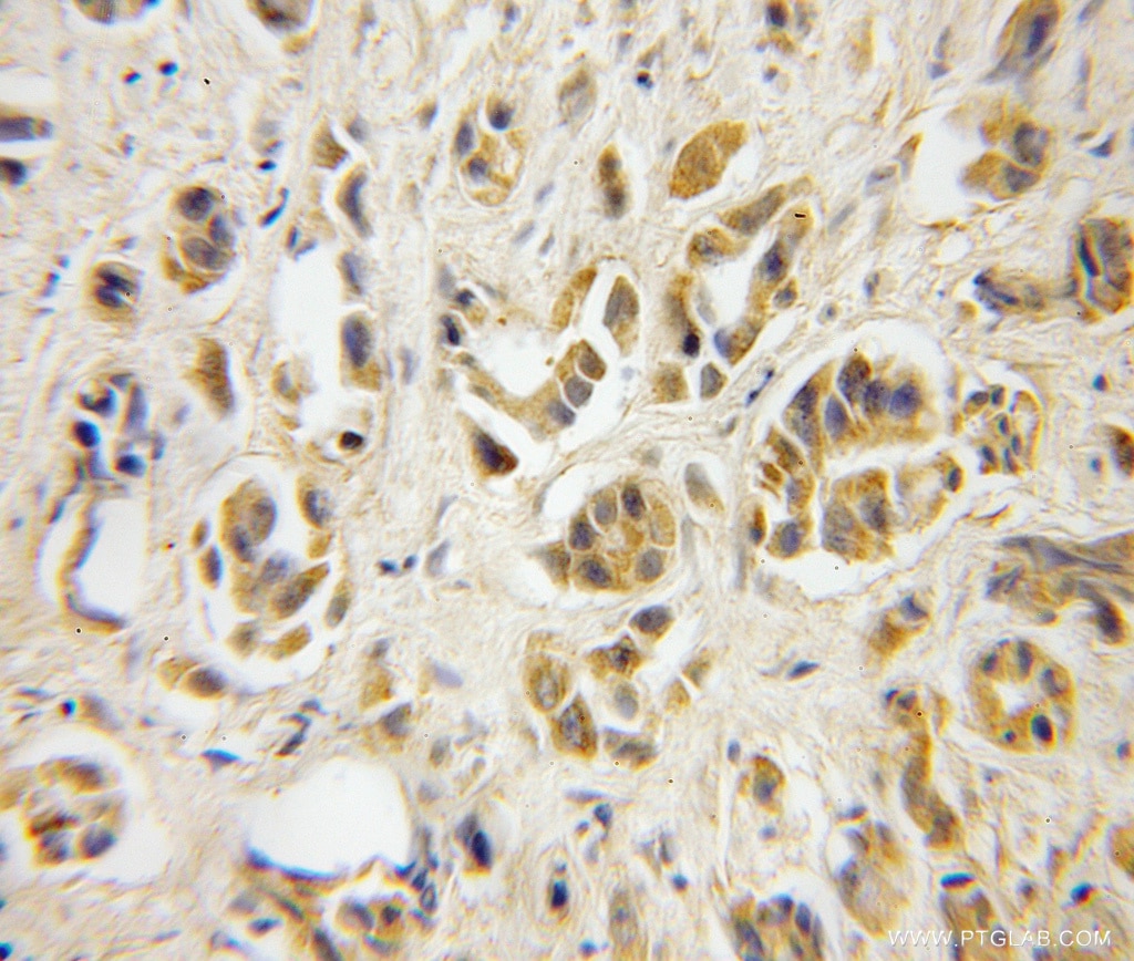 Immunohistochemistry (IHC) staining of human prostate cancer tissue using TBCA Polyclonal antibody (12304-1-AP)