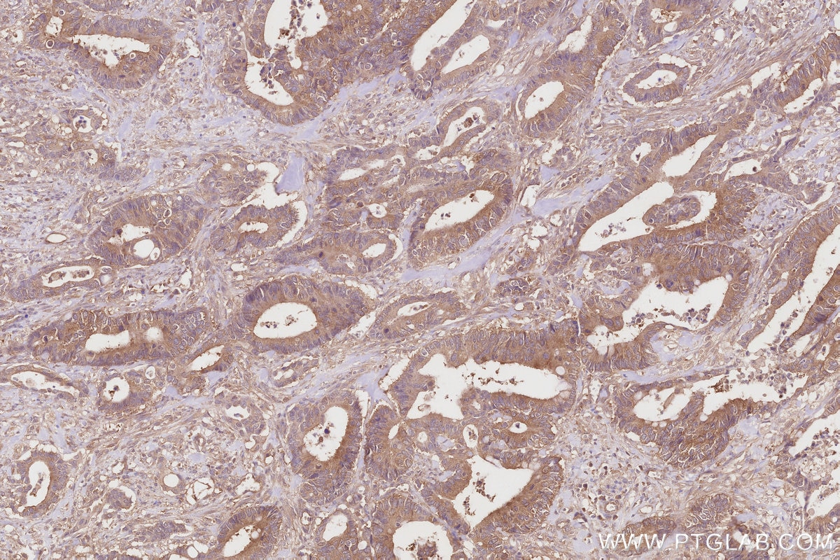 Immunohistochemistry (IHC) staining of human rectal cancer tissue using TBCD Polyclonal antibody (14867-1-AP)
