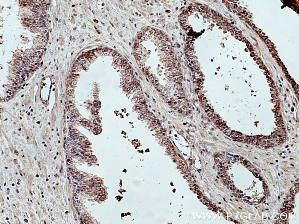 Immunohistochemistry (IHC) staining of human prostate cancer tissue using TBCE Polyclonal antibody (12021-1-AP)