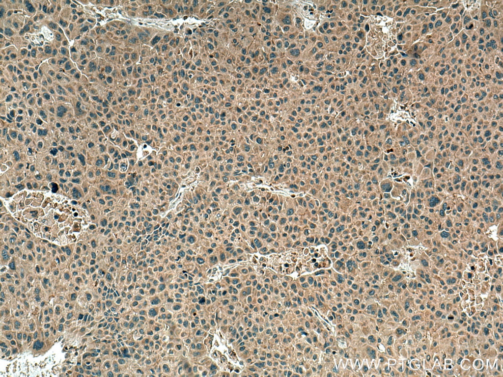 Immunohistochemistry (IHC) staining of human liver cancer tissue using TBK1 Polyclonal antibody (28397-1-AP)