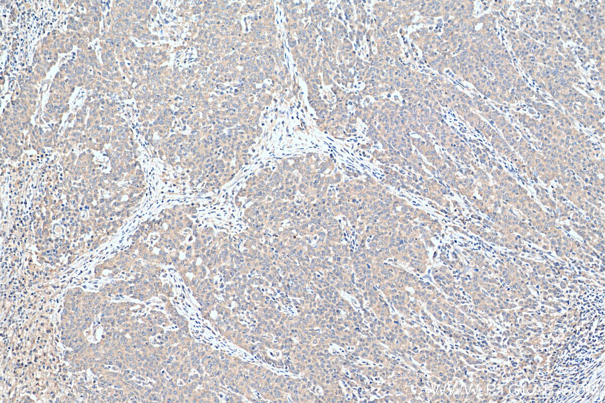 Immunohistochemistry (IHC) staining of human stomach cancer tissue using TBK1 Polyclonal antibody (28397-1-AP)