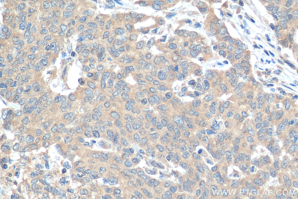 Immunohistochemistry (IHC) staining of human stomach cancer tissue using TBK1 Polyclonal antibody (28397-1-AP)