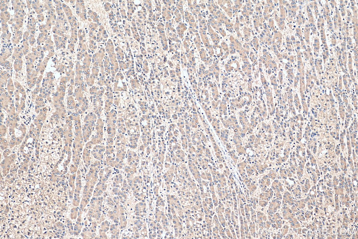 Immunohistochemistry (IHC) staining of human liver cancer tissue using TBK1 Polyclonal antibody (28397-1-AP)