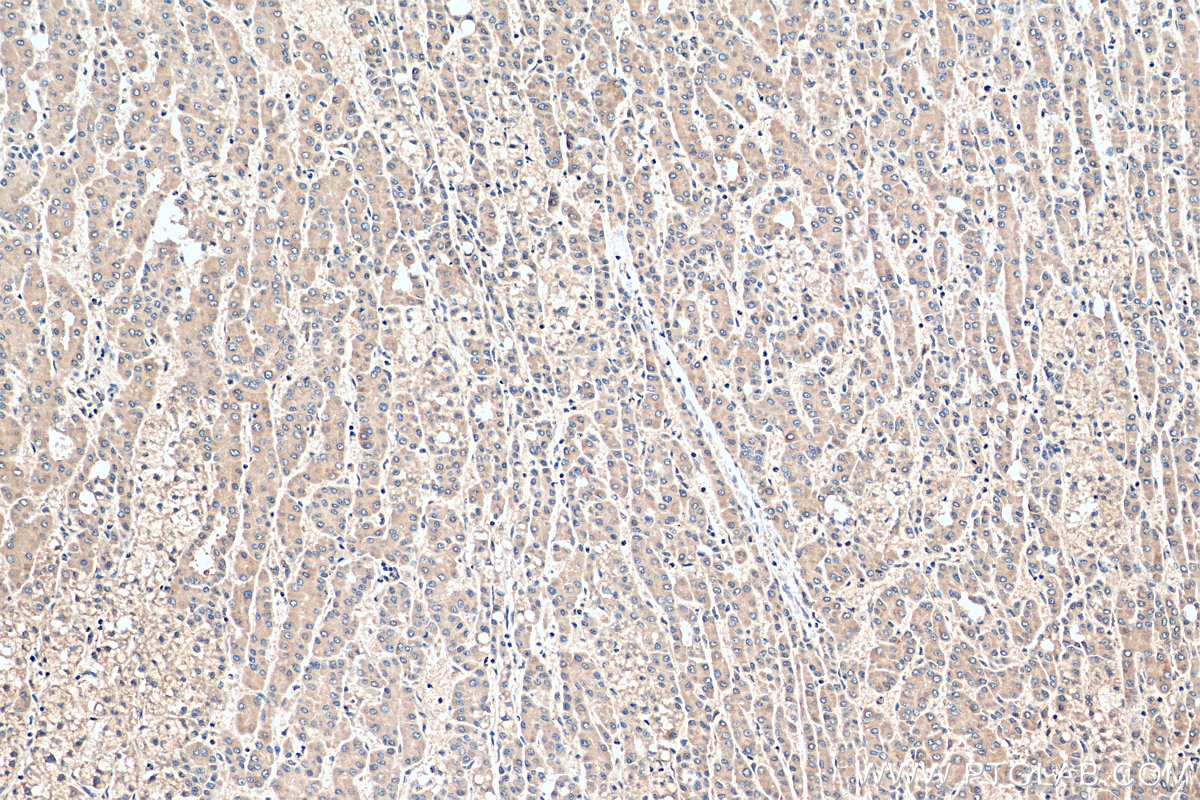 IHC staining of human liver cancer using 28397-1-AP