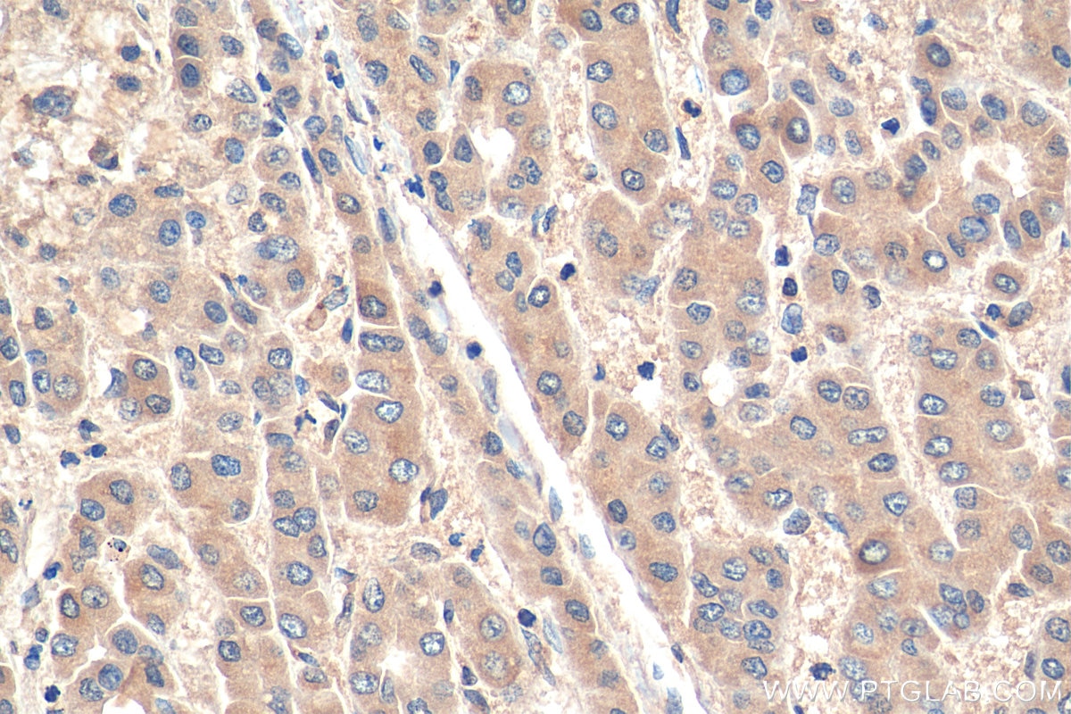 IHC staining of human liver cancer using 28397-1-AP