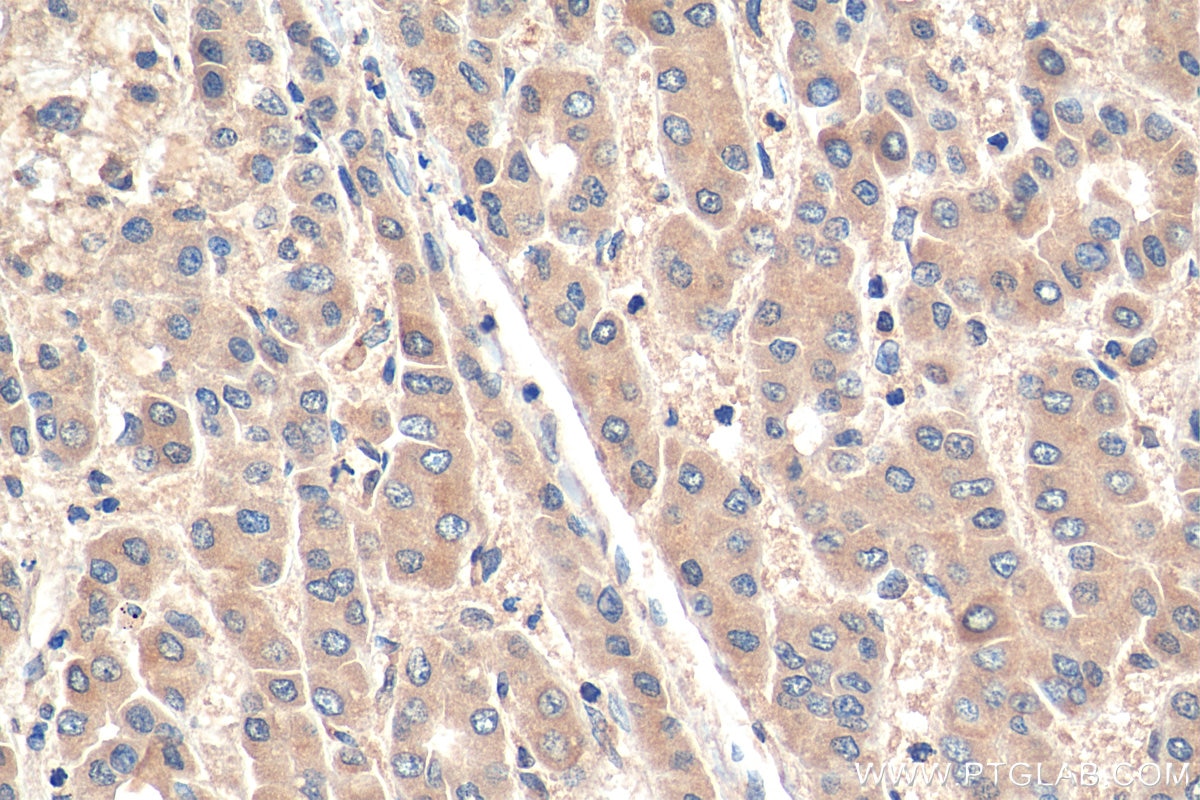 Immunohistochemistry (IHC) staining of human liver cancer tissue using TBK1 Polyclonal antibody (28397-1-AP)