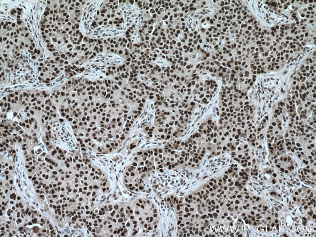 Immunohistochemistry (IHC) staining of human breast cancer tissue using TBL1X Monoclonal antibody (66955-1-Ig)