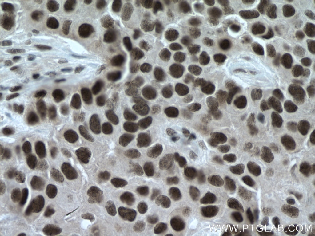 Immunohistochemistry (IHC) staining of human breast cancer tissue using TBL1X Monoclonal antibody (66955-1-Ig)