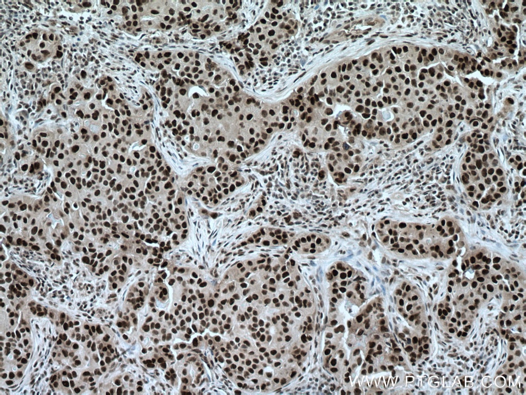 IHC staining of human breast cancer using 66955-1-Ig