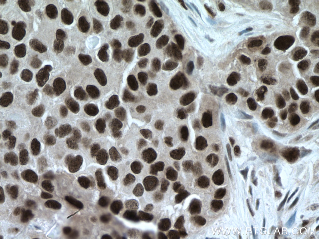 Immunohistochemistry (IHC) staining of human breast cancer tissue using TBL1X Monoclonal antibody (66955-1-Ig)