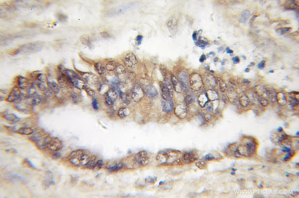 Immunohistochemistry (IHC) staining of human pancreas cancer tissue using TBL2 Polyclonal antibody (12488-1-AP)