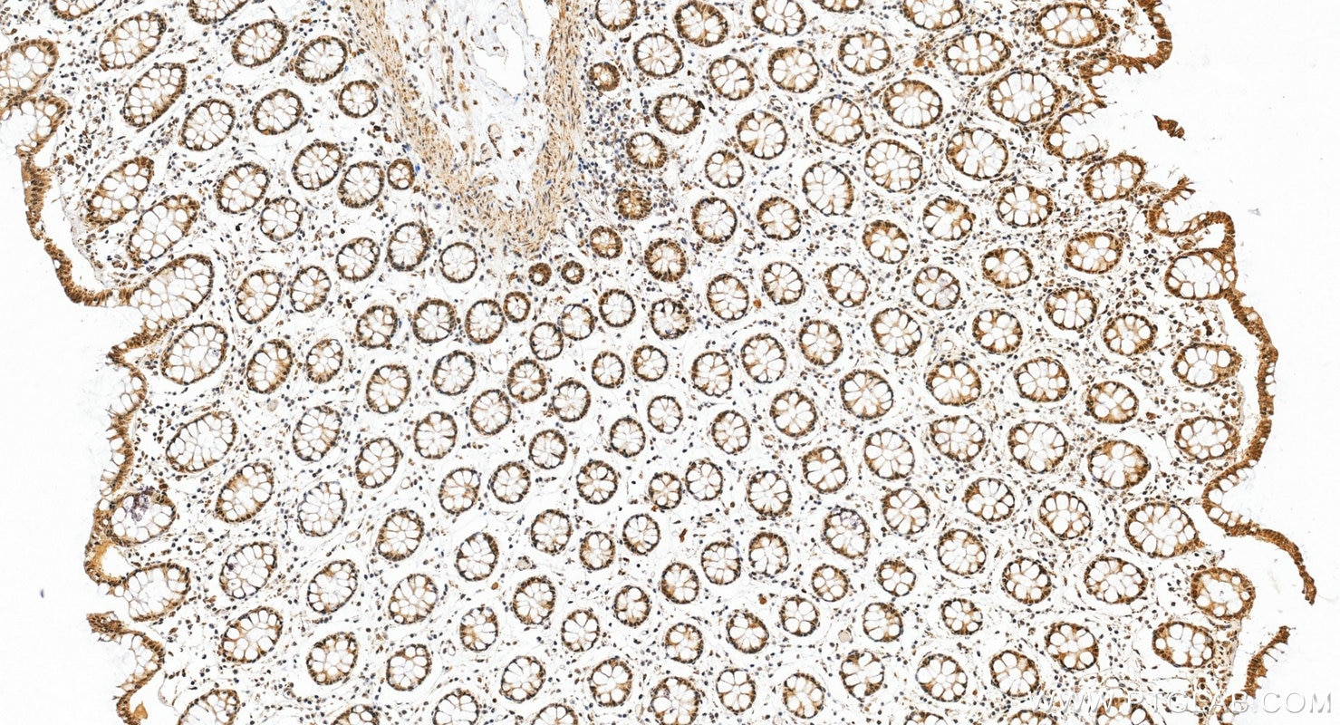 IHC staining of human colon using 22006-1-AP Immunohistochemistry (IHC) staining of human colon tissue using TBP Polyclonal antibody (22006-1-AP)