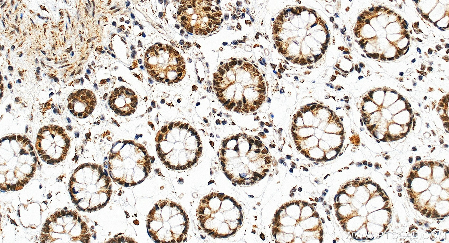 IHC staining of human colon using 22006-1-AP Immunohistochemistry (IHC) staining of human colon tissue using TBP Polyclonal antibody (22006-1-AP)