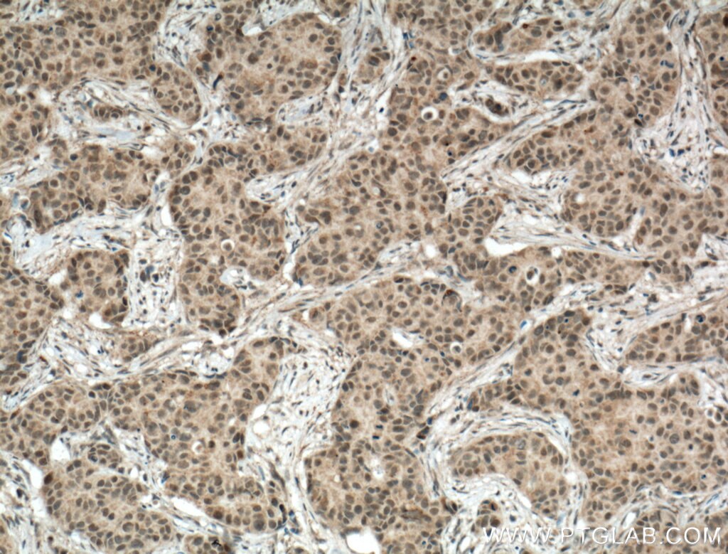 Immunohistochemistry (IHC) staining of human breast cancer tissue using TBP Polyclonal antibody (22006-1-AP)