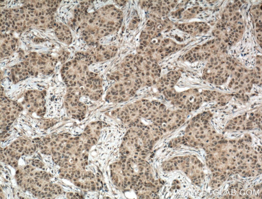 IHC staining of human breast cancer using 22006-1-AP