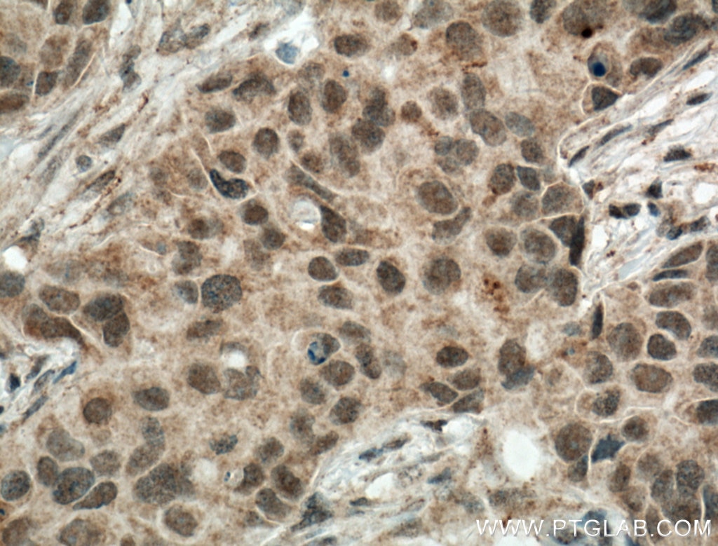 IHC staining of human breast cancer using 22006-1-AP