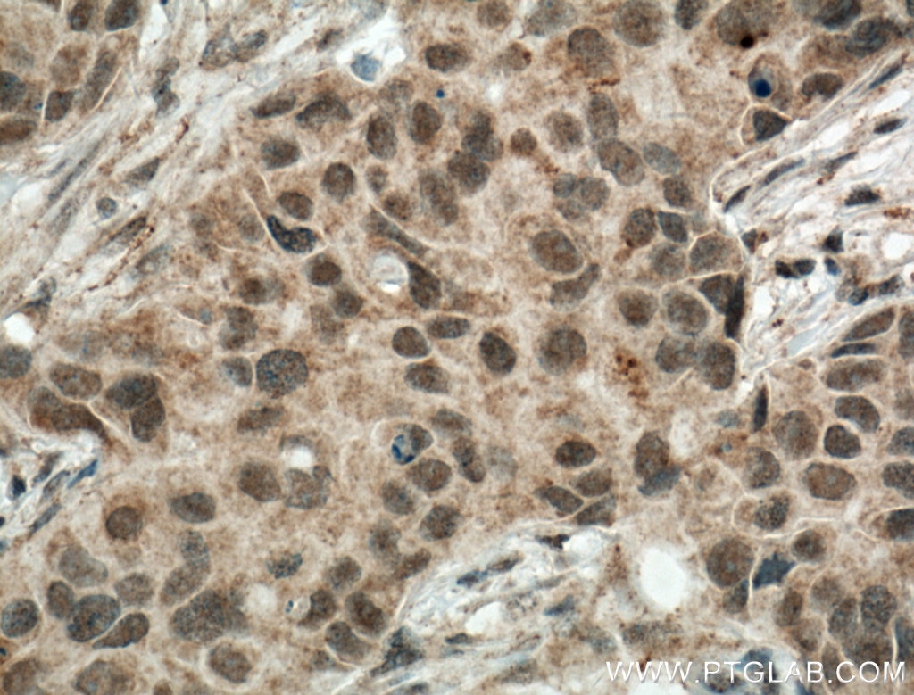 Immunohistochemistry (IHC) staining of human breast cancer tissue using TBP Polyclonal antibody (22006-1-AP)