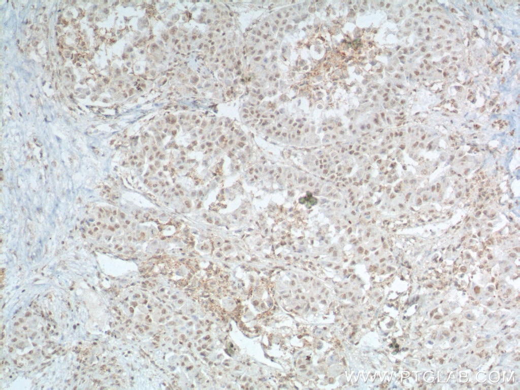 Immunohistochemistry (IHC) staining of human liver cancer tissue using TBP Monoclonal antibody (66166-1-Ig)