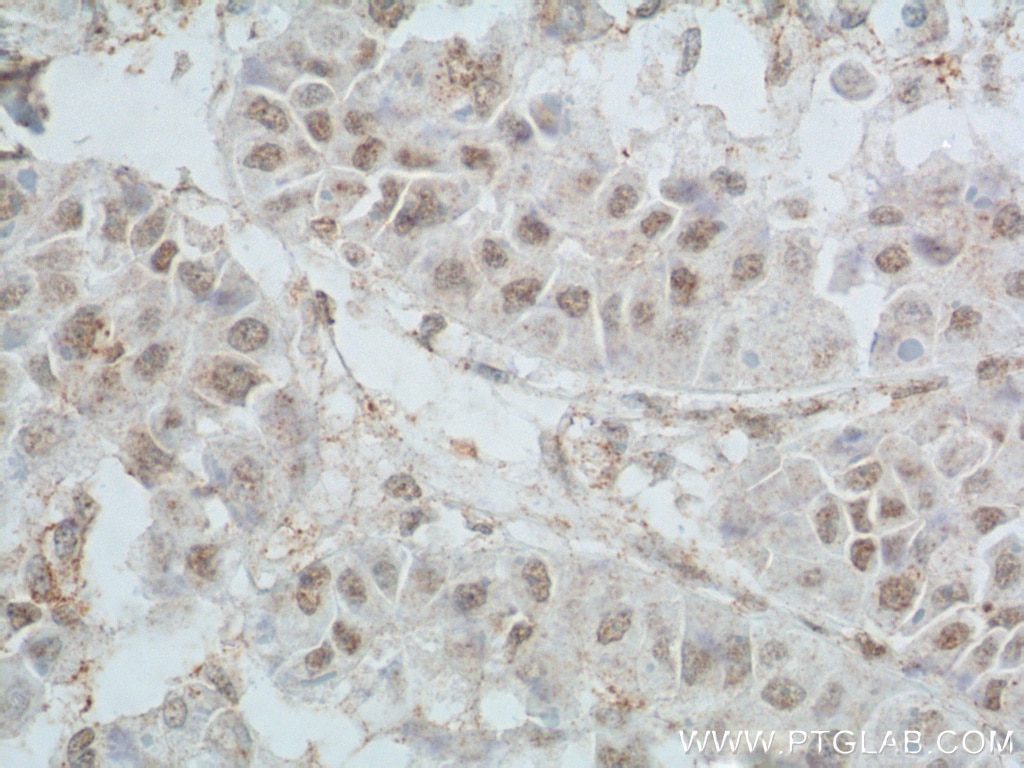 Immunohistochemistry (IHC) staining of human liver cancer tissue using TBP Monoclonal antibody (66166-1-Ig)