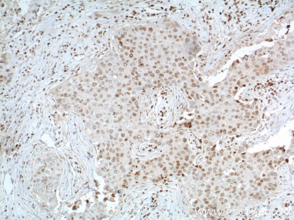 Immunohistochemistry (IHC) staining of human breast cancer tissue using TBP Monoclonal antibody (66166-1-Ig)