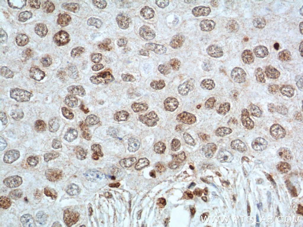 Immunohistochemistry (IHC) staining of human breast cancer tissue using TBP Monoclonal antibody (66166-1-Ig)