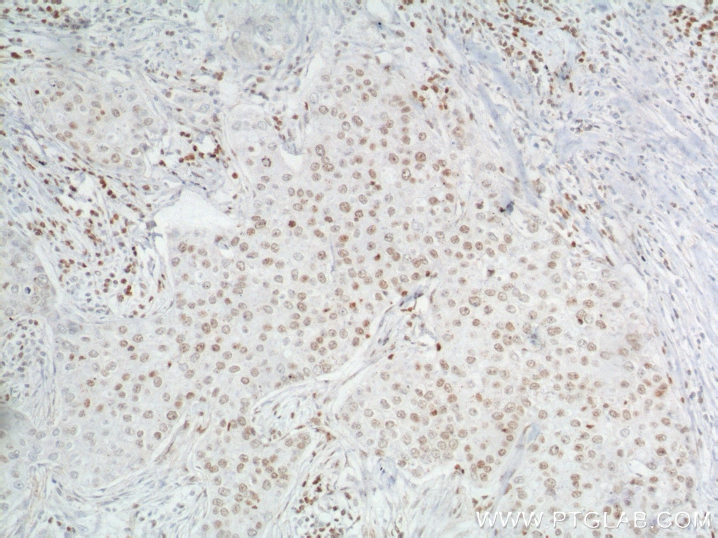 Immunohistochemistry (IHC) staining of human breast cancer tissue using TBP Monoclonal antibody (66166-1-Ig)