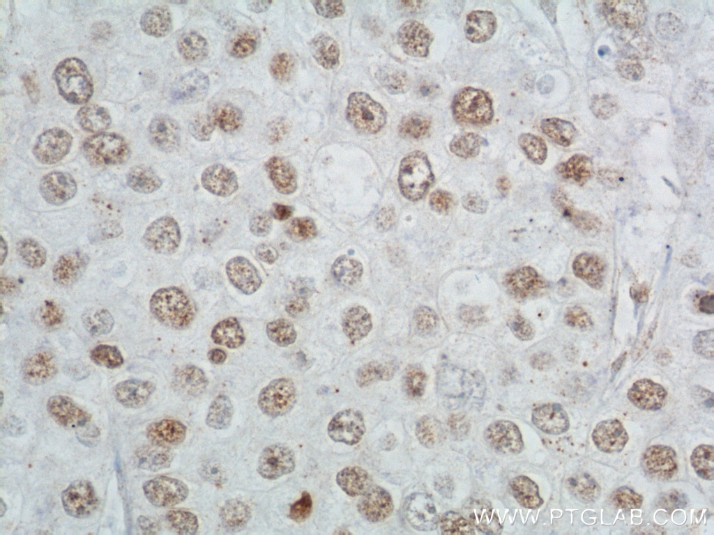 Immunohistochemistry (IHC) staining of human breast cancer tissue using TBP Monoclonal antibody (66166-1-Ig)