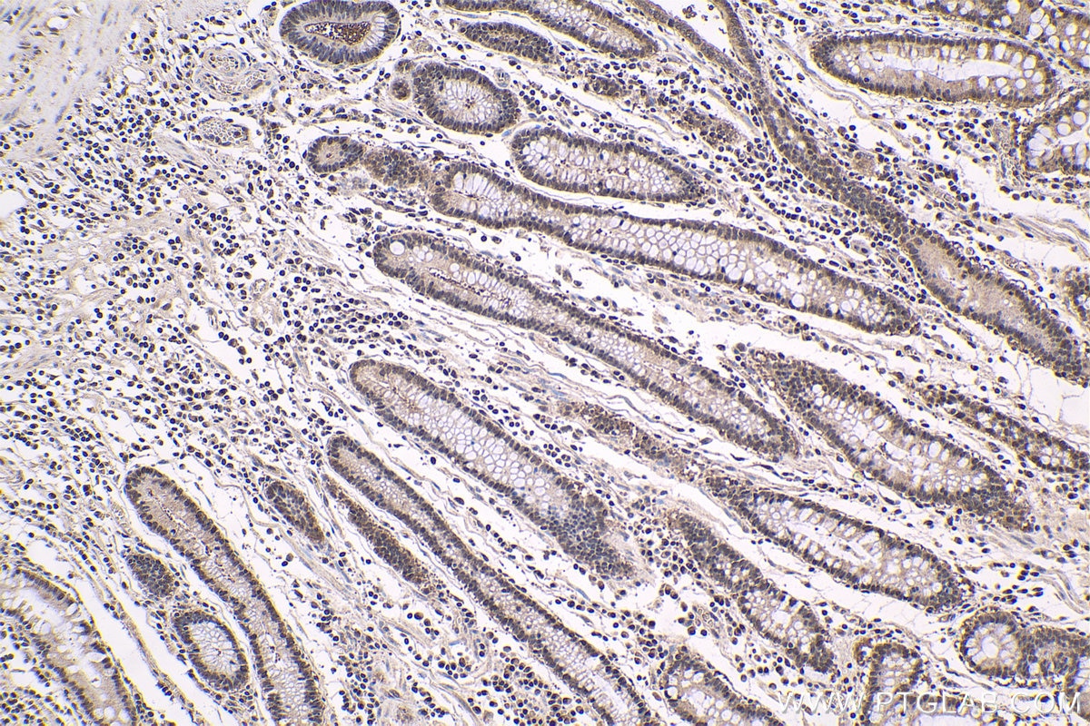 Immunohistochemistry (IHC) staining of human stomach cancer tissue using TBPL1 Polyclonal antibody (12258-1-AP)