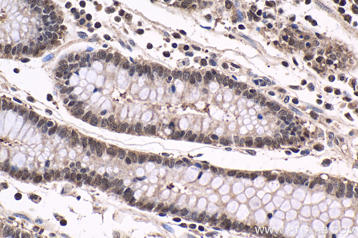 Immunohistochemistry (IHC) staining of human stomach cancer tissue using TBPL1 Polyclonal antibody (12258-1-AP)
