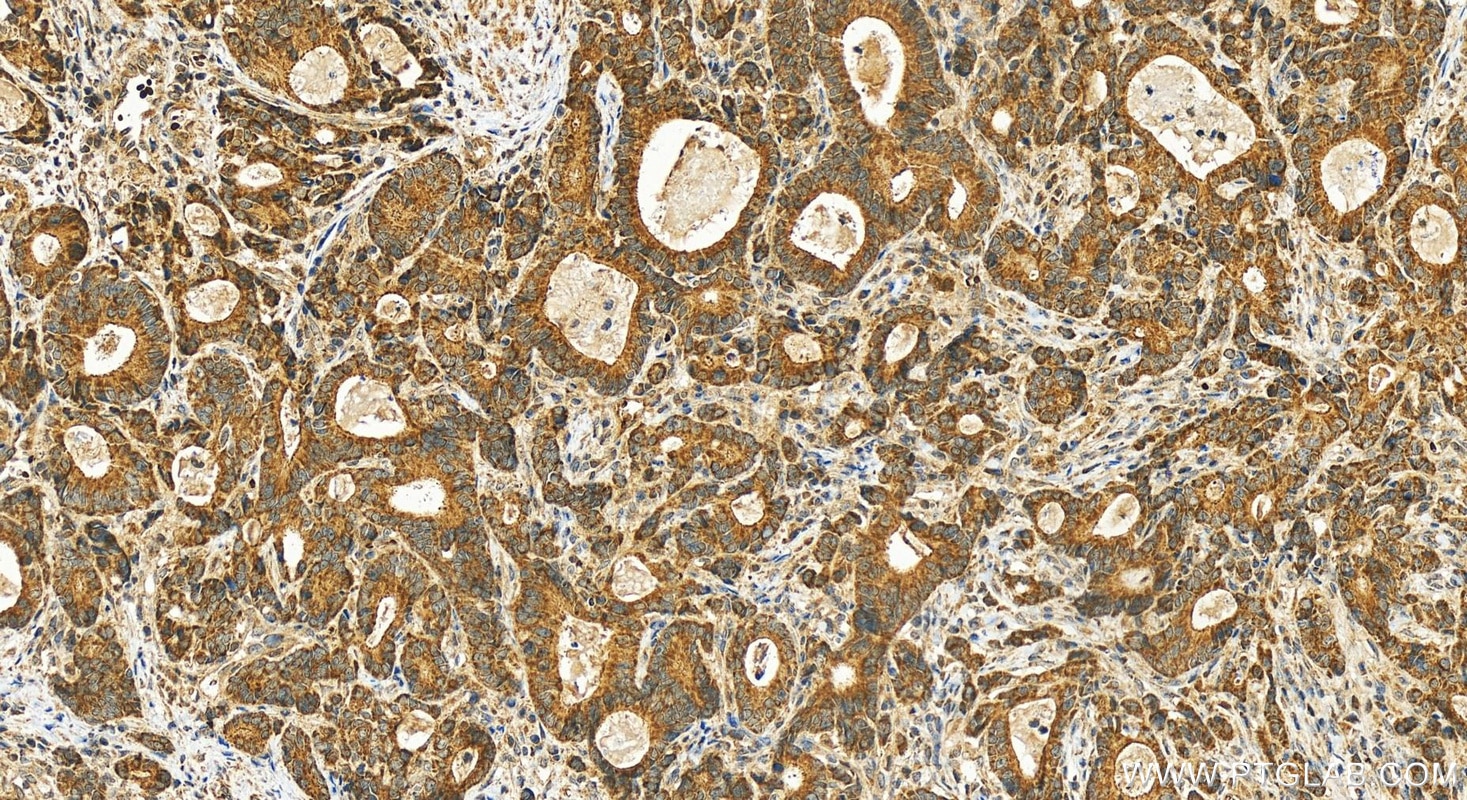 Immunohistochemistry (IHC) staining of human stomach cancer tissue using TBRG4 Polyclonal antibody (10177-2-AP)