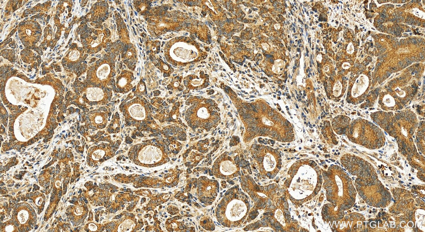 Immunohistochemistry (IHC) staining of human stomach cancer tissue using TBRG4 Polyclonal antibody (10177-2-AP)