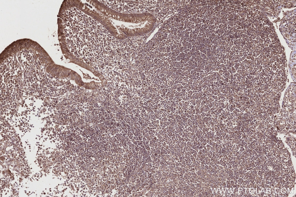 Immunohistochemistry (IHC) staining of human appendicitis tissue using TBRG4 Polyclonal antibody (10177-2-AP)