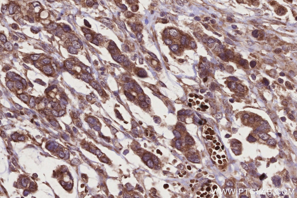 Immunohistochemistry (IHC) staining of human stomach cancer tissue using TBRG4 Polyclonal antibody (10177-2-AP)