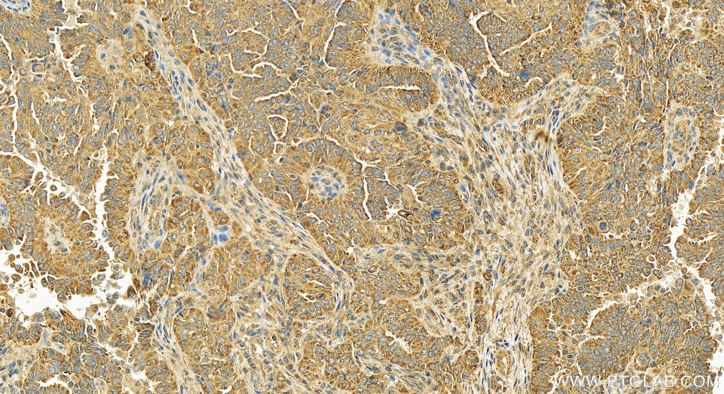Immunohistochemistry (IHC) staining of human ovary cancer tissue using TBRG4 Polyclonal antibody (10177-2-AP)
