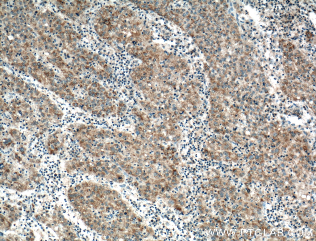 Immunohistochemistry (IHC) staining of human liver cancer tissue using TBRG4 Polyclonal antibody (16245-1-AP)