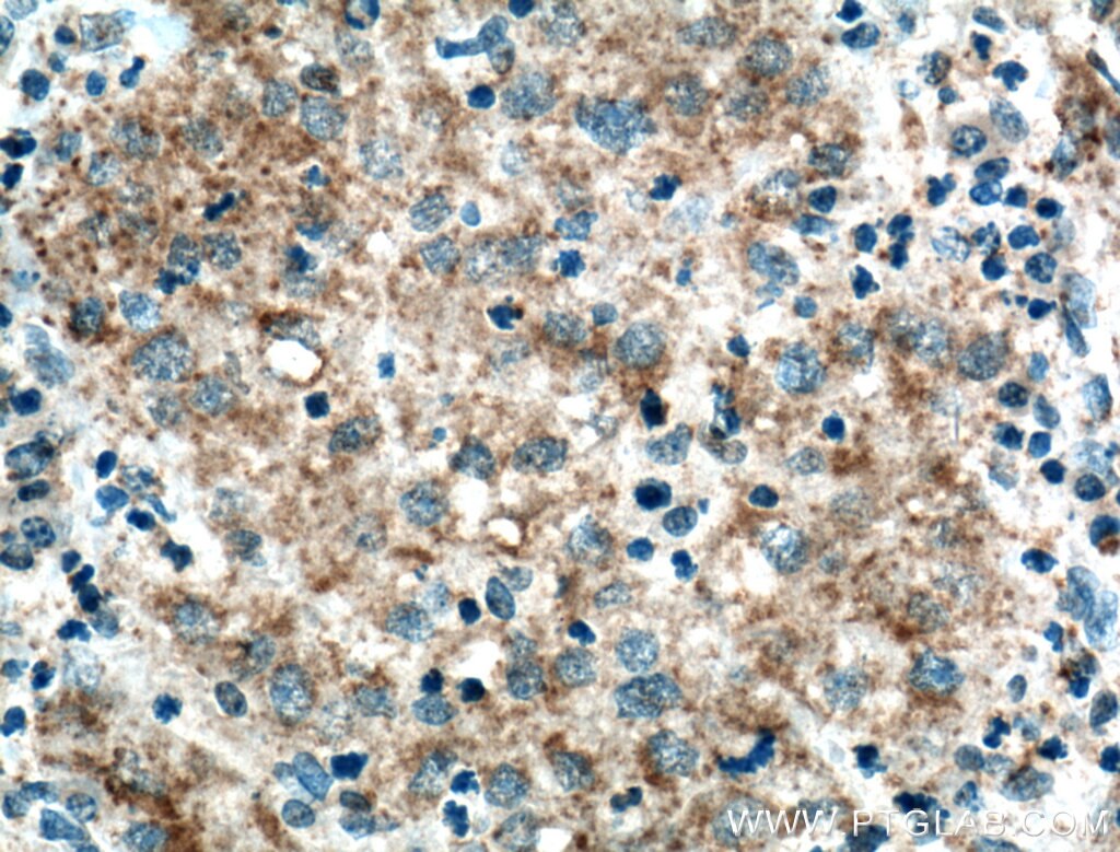 Immunohistochemistry (IHC) staining of human liver cancer tissue using TBRG4 Polyclonal antibody (16245-1-AP)