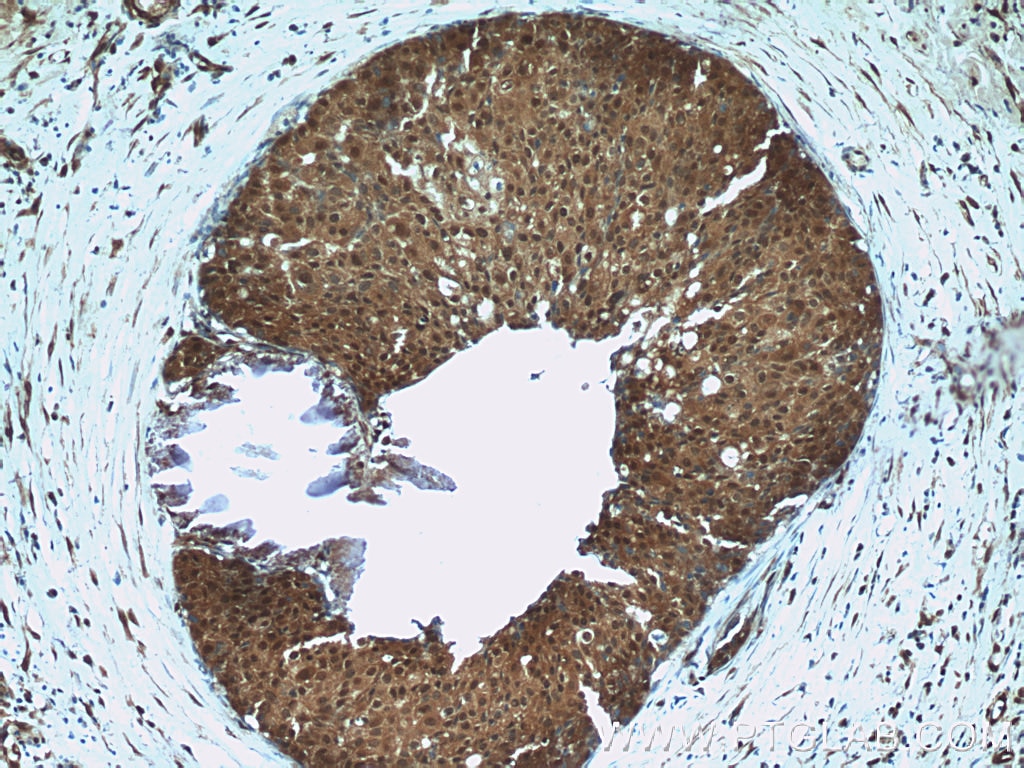 IHC staining of human breast cancer using 23237-1-AP