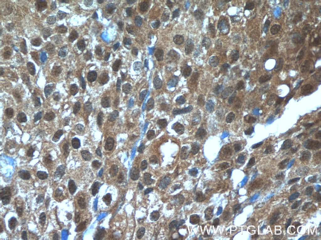 Immunohistochemistry (IHC) staining of human breast cancer tissue using TBX18 Polyclonal antibody (23237-1-AP)