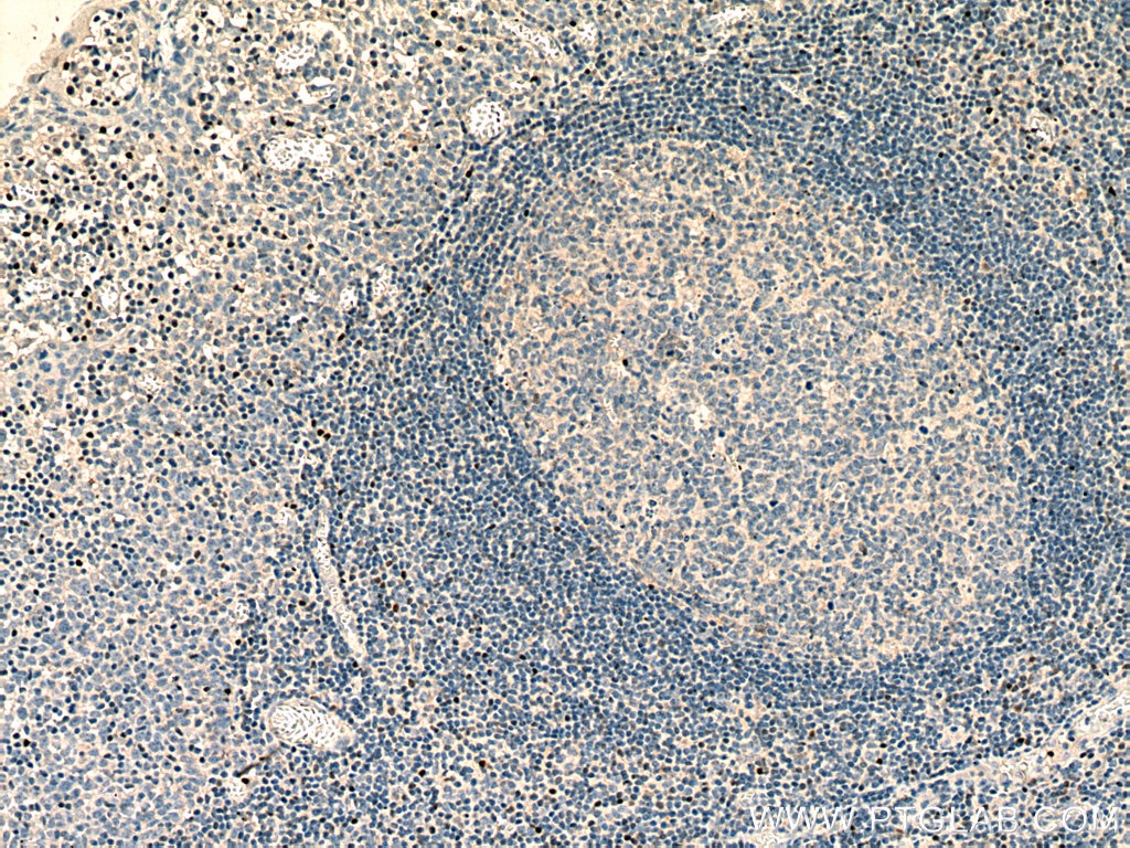 IHC staining of human tonsillitis using 13700-1-AP