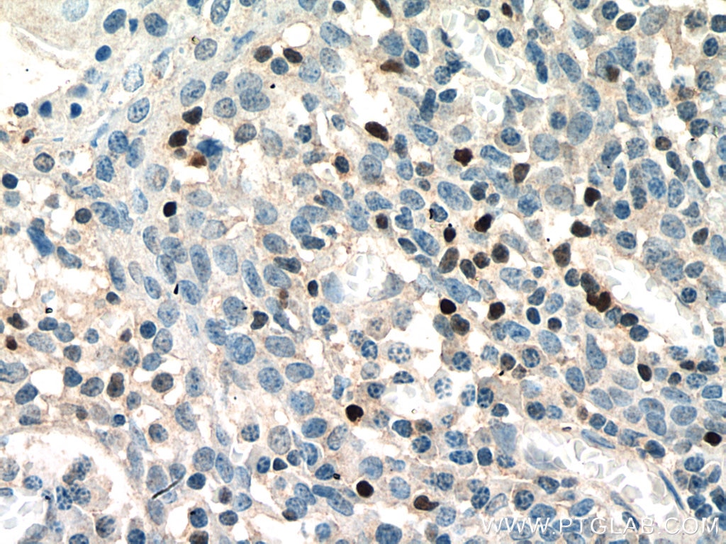 Immunohistochemistry (IHC) staining of human tonsillitis tissue using TBX21,T-bet Polyclonal antibody (13700-1-AP)