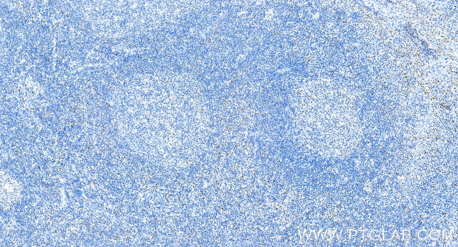 IHC staining of human tonsillitis using 83804-10-RR Immunohistochemistry (IHC) staining of human tonsillitis tissue using TBX21/T-bet Recombinant monoclonal antibody (83804-10-RR)