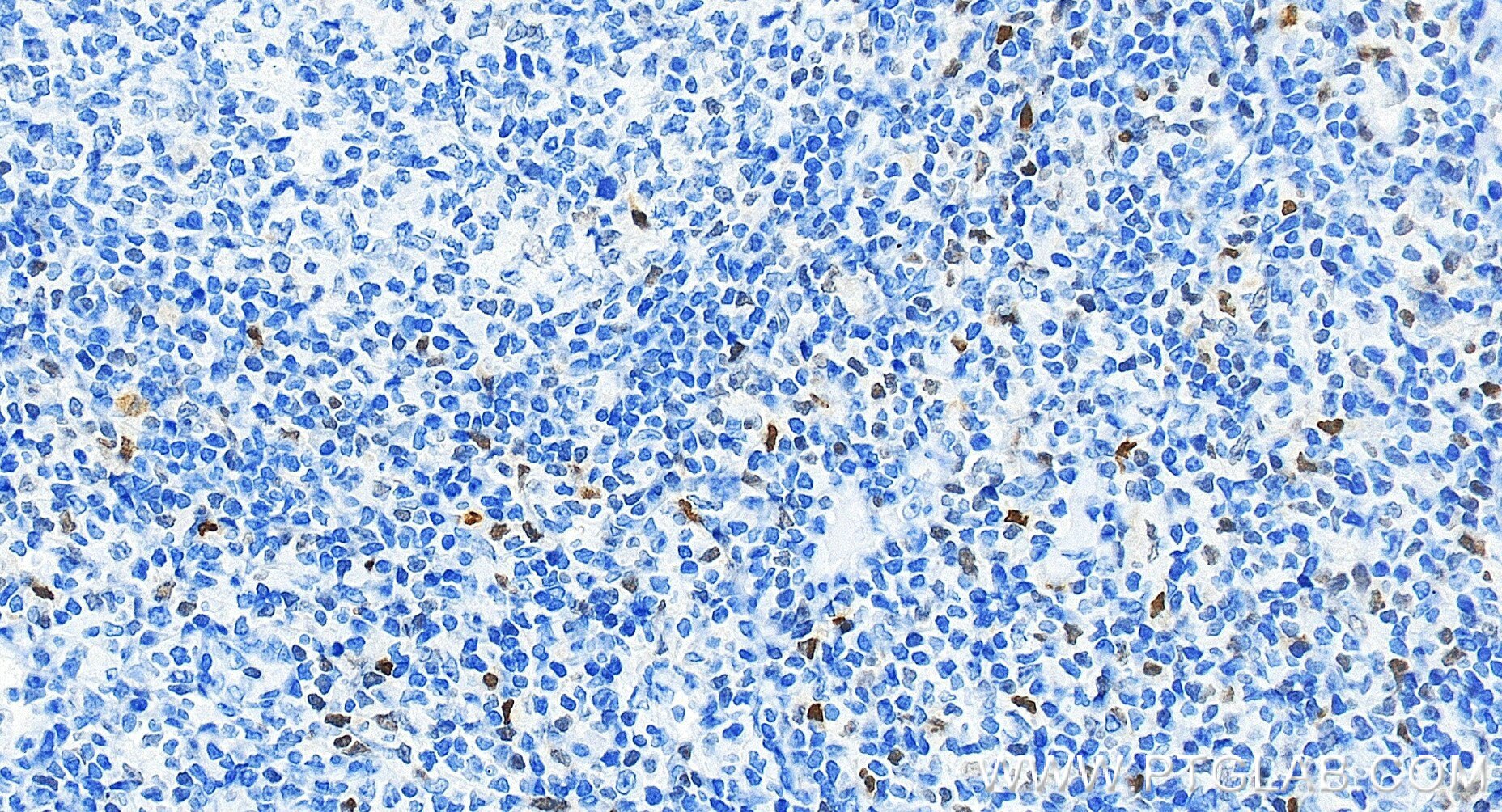 IHC staining of human tonsillitis using 83804-10-RR Immunohistochemistry (IHC) staining of human tonsillitis tissue using TBX21/T-bet Recombinant monoclonal antibody (83804-10-RR)