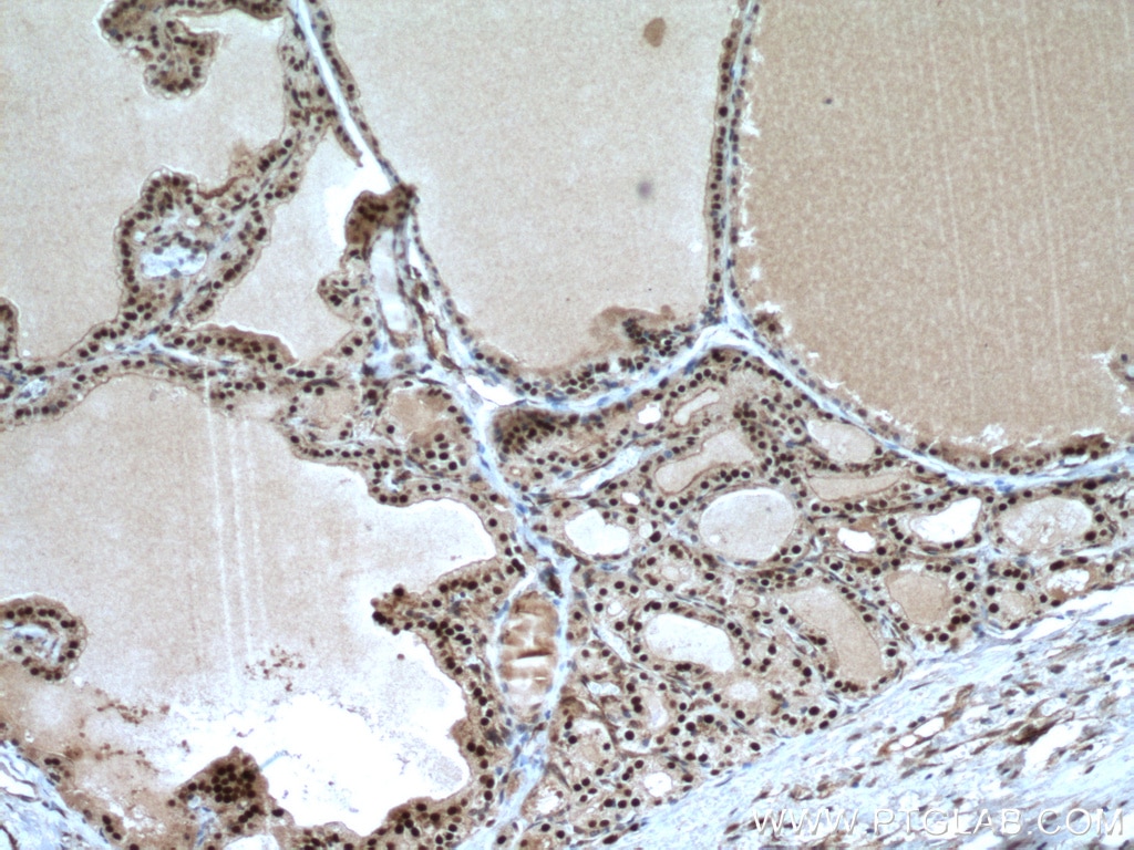 Immunohistochemistry (IHC) staining of human thyroid cancer tissue using TBX3 Polyclonal antibody (16741-1-AP)
