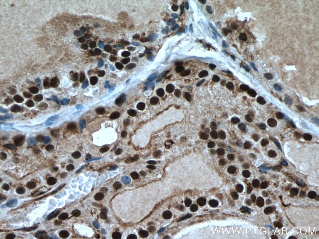 Immunohistochemistry (IHC) staining of human thyroid cancer tissue using TBX3 Polyclonal antibody (16741-1-AP)