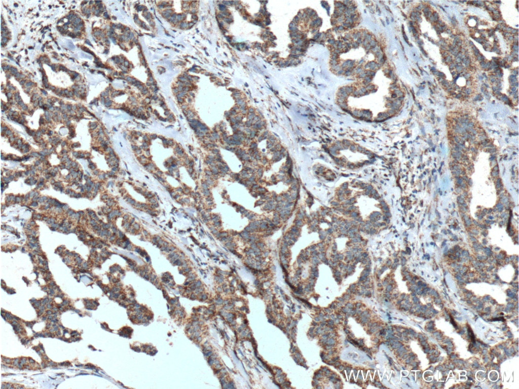 Immunohistochemistry (IHC) staining of human breast cancer tissue using TBXA2R Polyclonal antibody (27159-1-AP)