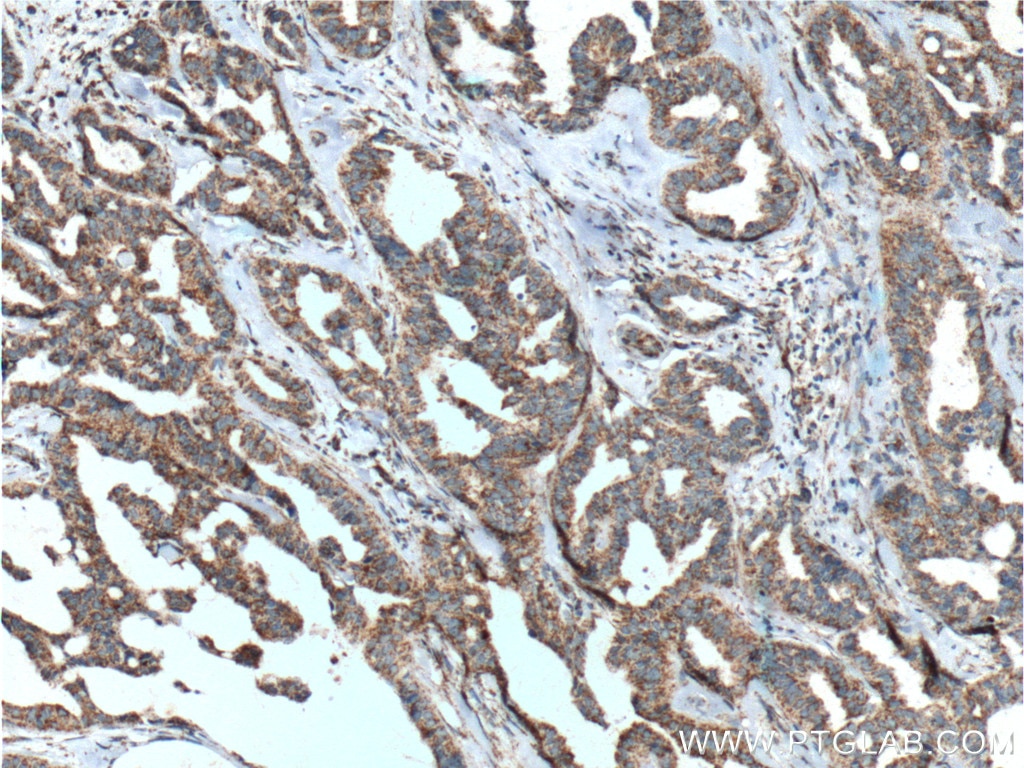 IHC staining of human breast cancer using 27159-1-AP