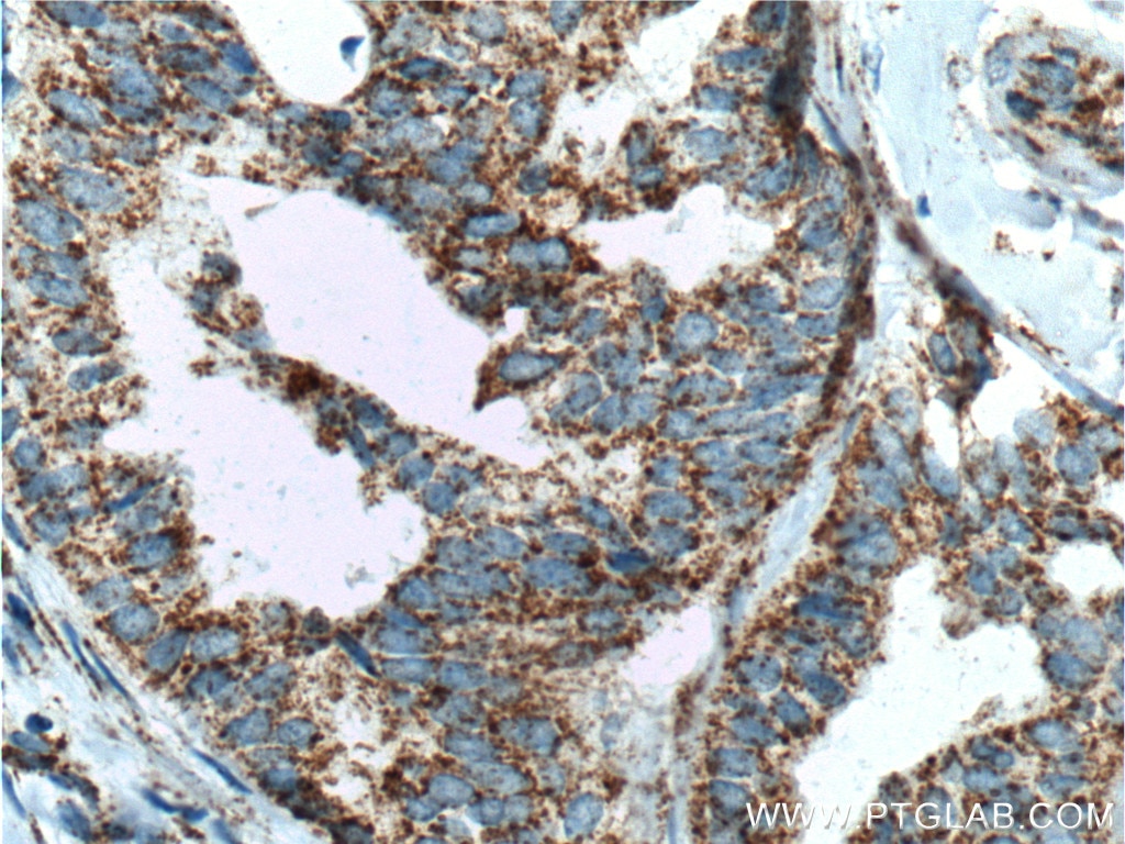 Immunohistochemistry (IHC) staining of human breast cancer tissue using TBXA2R Polyclonal antibody (27159-1-AP)