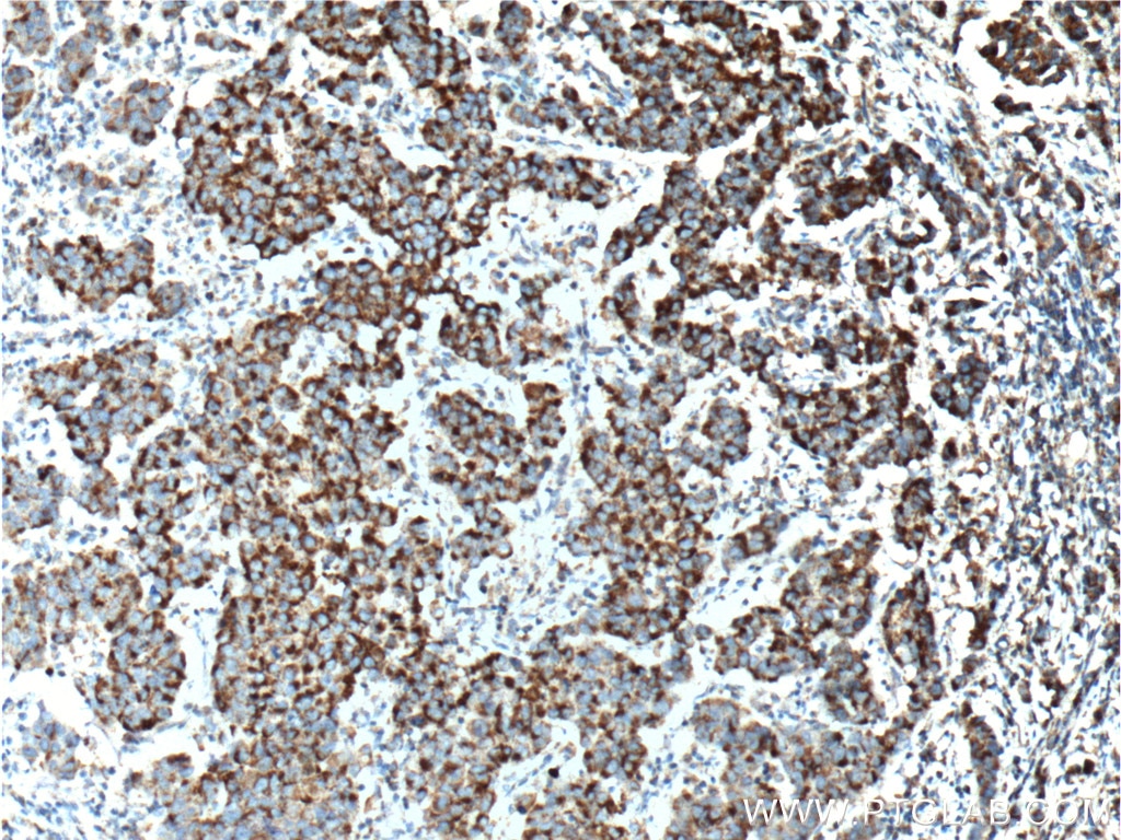 Immunohistochemistry (IHC) staining of human prostate cancer tissue using TBXA2R Polyclonal antibody (27159-1-AP)