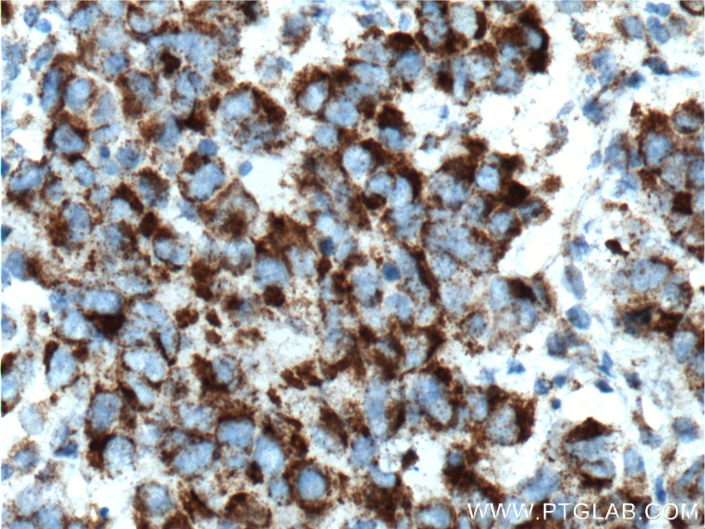 Immunohistochemistry (IHC) staining of human prostate cancer tissue using TBXA2R Polyclonal antibody (27159-1-AP)